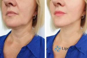 Double chin before and after Hi-Fu treatment 4 Book your double chin treatment Coombe today! We are here to help!