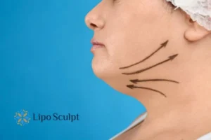 Double chin before and after Hi-Fu treatment 3 Boost your confidence with a Double chin treatment Coombe