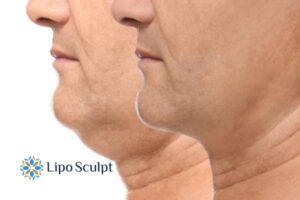 Double chin before and after Hi-Fu treatment 2 Double chin treatment Coombe from Lipo Sculpt - feel more confident today!