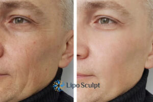 How to Fight Aging Symptoms 3 Fight Aging Symptoms Coombe With HIFU and Morpheus8 Today!