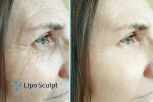 How to Fight Aging Symptoms 2 Do you want to Fight Aging Symptoms Coombe? Contact Lipo Sculpt today!