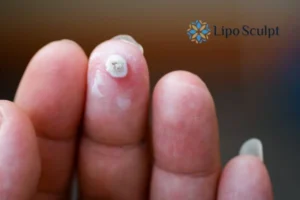 Cryopen Top 5 Treatable Conditions 4 Do you have a persistent wart of verruca that you cannot shit? Cryopen Coombe treatment will work call us NOW!