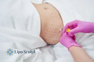 Are The Results From Aqualyx Permanent? 1 Do you want to know how long Aqualyx Coombe results last?