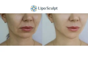 Explaining Total Skin Tightening Treatment And What It Can Do For You 2 Do you want to boost your self confidence? Give Morpheus8 Coombe a try today!