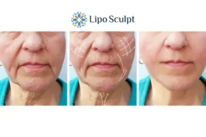 Explaining Total Skin Tightening Treatment And What It Can Do For You 3 Boost your confidence with Morpheus8 Coombe call our team today!