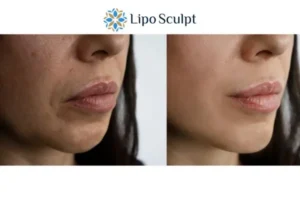 Explaining Total Skin Tightening Treatment And What It Can Do For You 4 Morpheus8 Coombe the best results - call our team today!