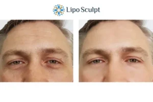 Explaining Total Skin Tightening Treatment And What It Can Do For You 6 Morpheus8 Coombe book in today to find out more!