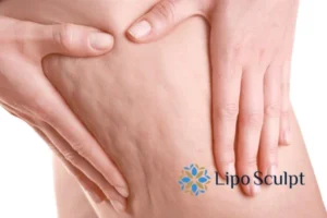 CoolSculpting for Legs: The Innovative Approach to Redefining Your Legs 5 Start your journey today book your coolsculpting treatment Coombe online today!