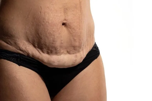 Lost the Weight but Not the Loose Skin? 1 image of womans stomach after weight loss showing loose skin Coombe